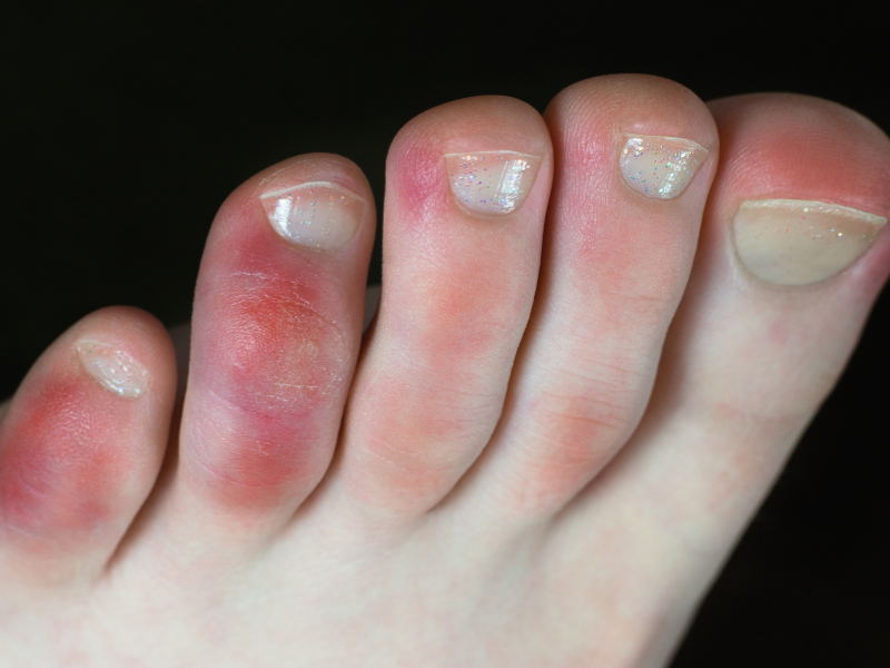 Diagnosis of Finger & Toe Pain